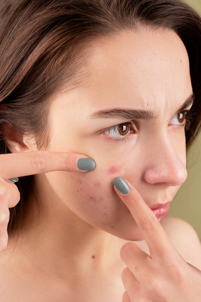 Une femme avec des acnés sur le visage